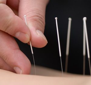 Acupuncture Needle (100 ps.) Avaleble in all sizes