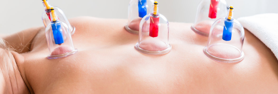 Alternative practitioner cupping woman in course of alternative therapy treatment